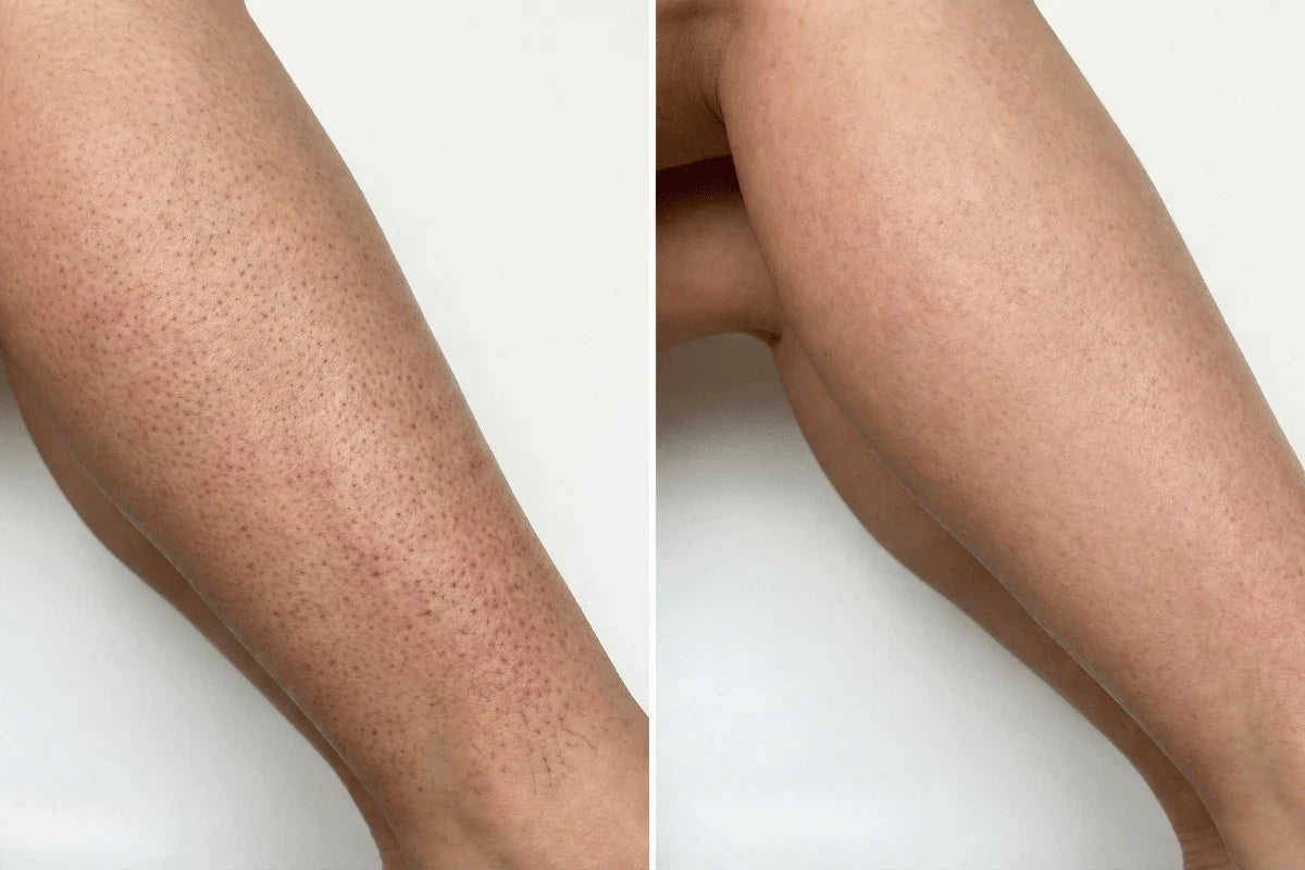 The Secret to Smoothing the Appearance of Strawberry Legs and KP at Home